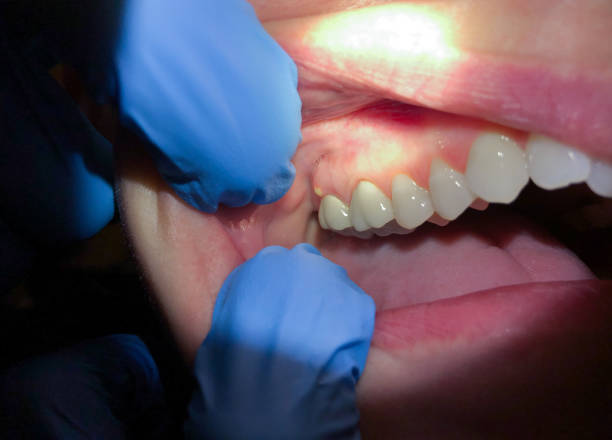 Best Emergency Tooth Extraction in Papillion, NE