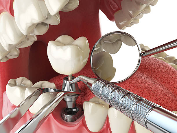 Best Emergency Dental Care for Broken or Chipped Teeth in Papillion, NE
